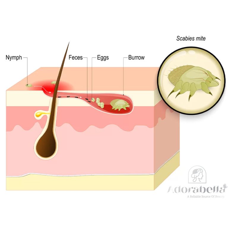 Skin Diseases: Human Scabies