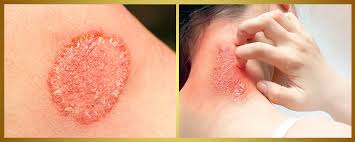 Fungal Infection